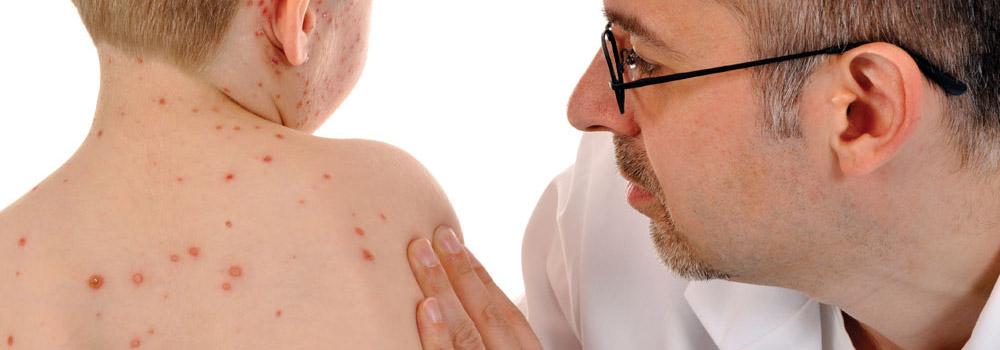 Chickenpox & measles